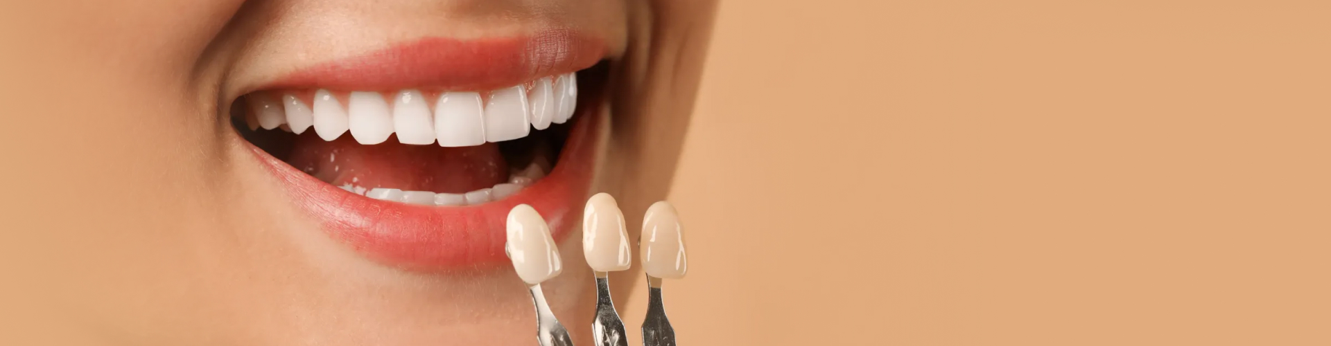 Close-up of a bright smile matching porcelain veneer shades for cosmetic dentistry treatment.